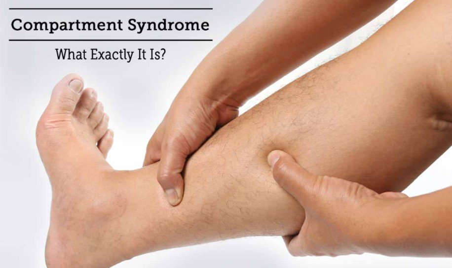 What Is Compartment Syndrome