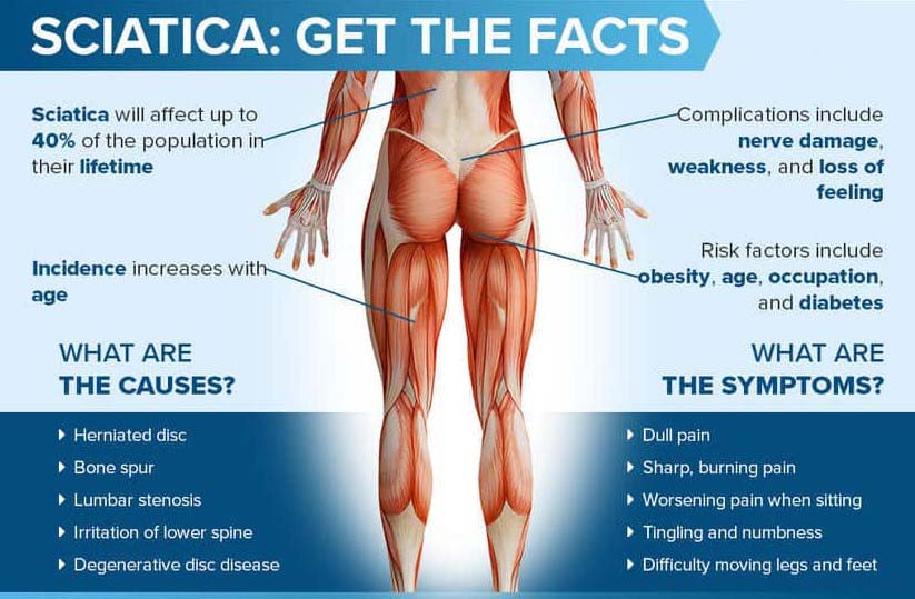 What-is-Sciatica