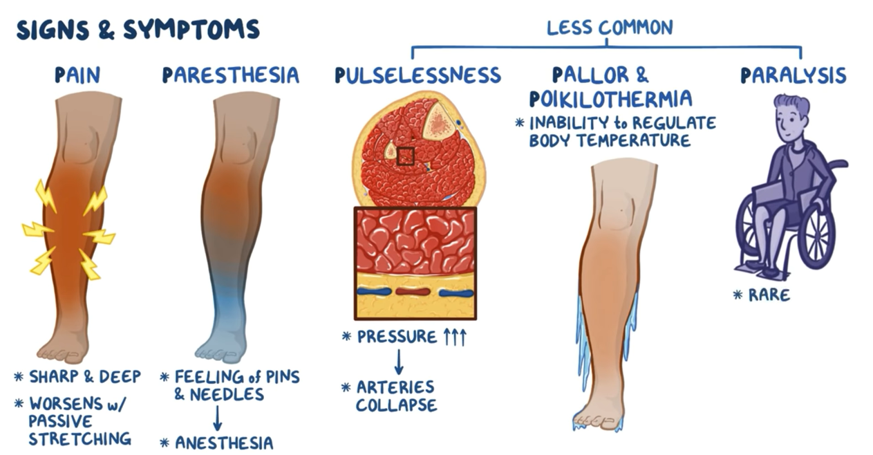 signs of compartment syndrome