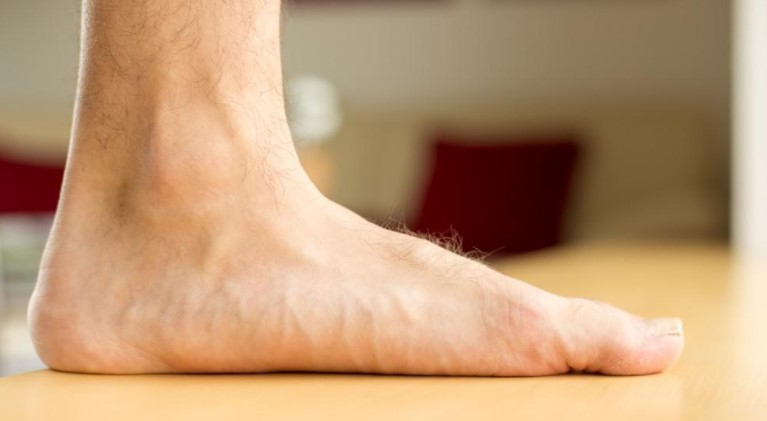 Causes of Flat feet